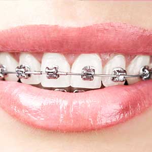 Adult Braces | Tooth Suite Family Dentistry | General Dentist | Lloydminster