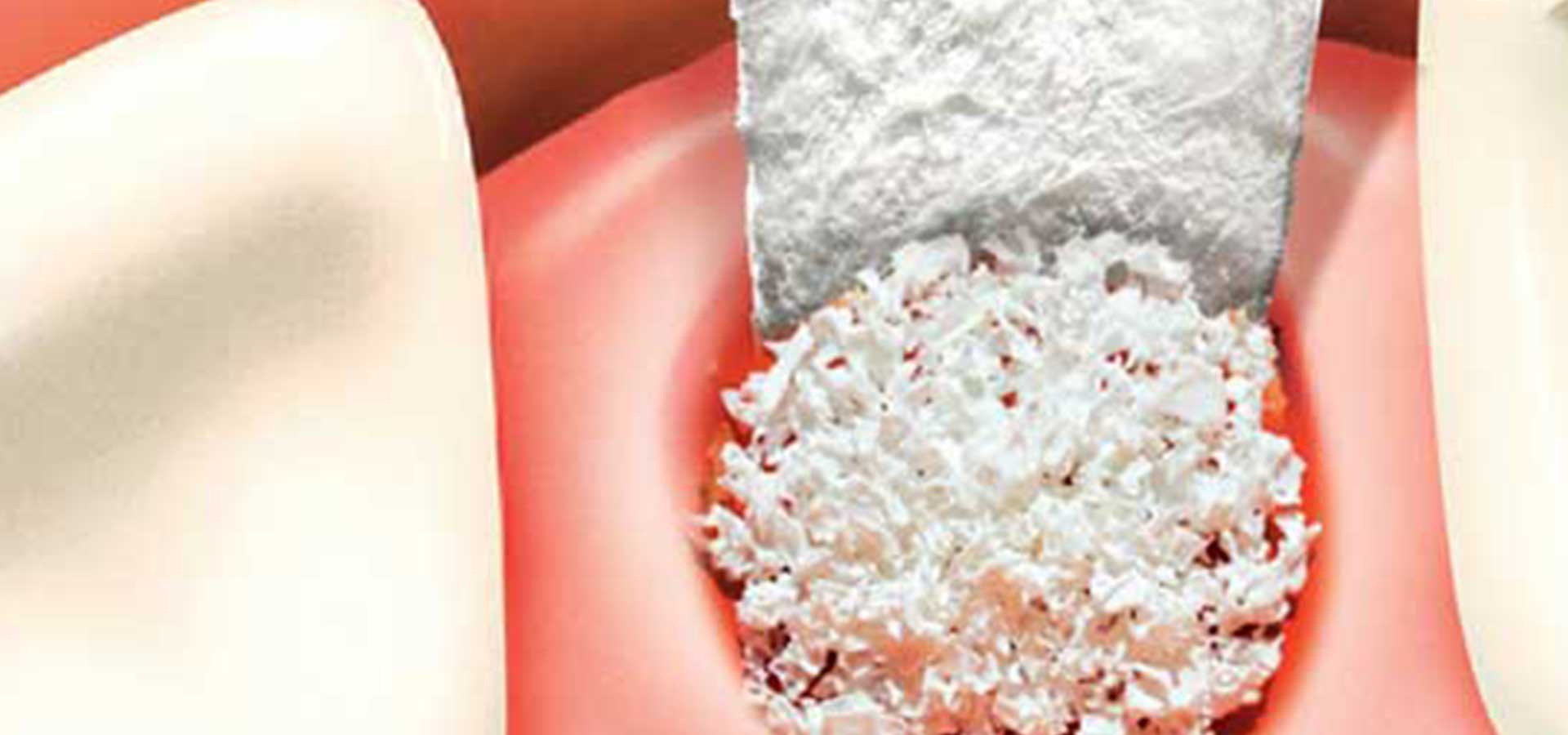 Dental Bone Graft | Tooth Suite Family Dentistry | General Dentist | Lloydminster