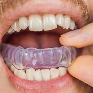 Custom Mouth Sportsguard | Tooth Suite Family Dentistry | General Dentist | Lloydminster