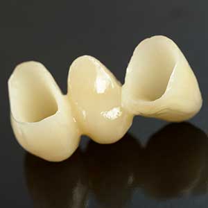 Dental Bridge | Tooth Suite Family Dentistry | General Dentist | Lloydminster