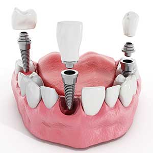 Dental Implants | Tooth Suite Family Dentistry | General Dentist | Lloydminster