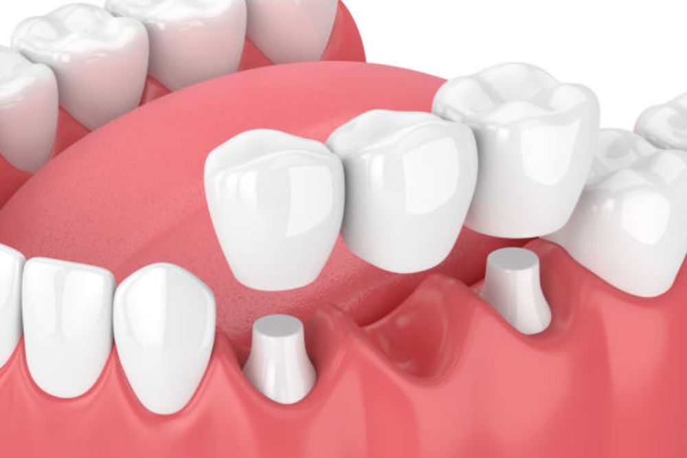 Dental Bridges Near You