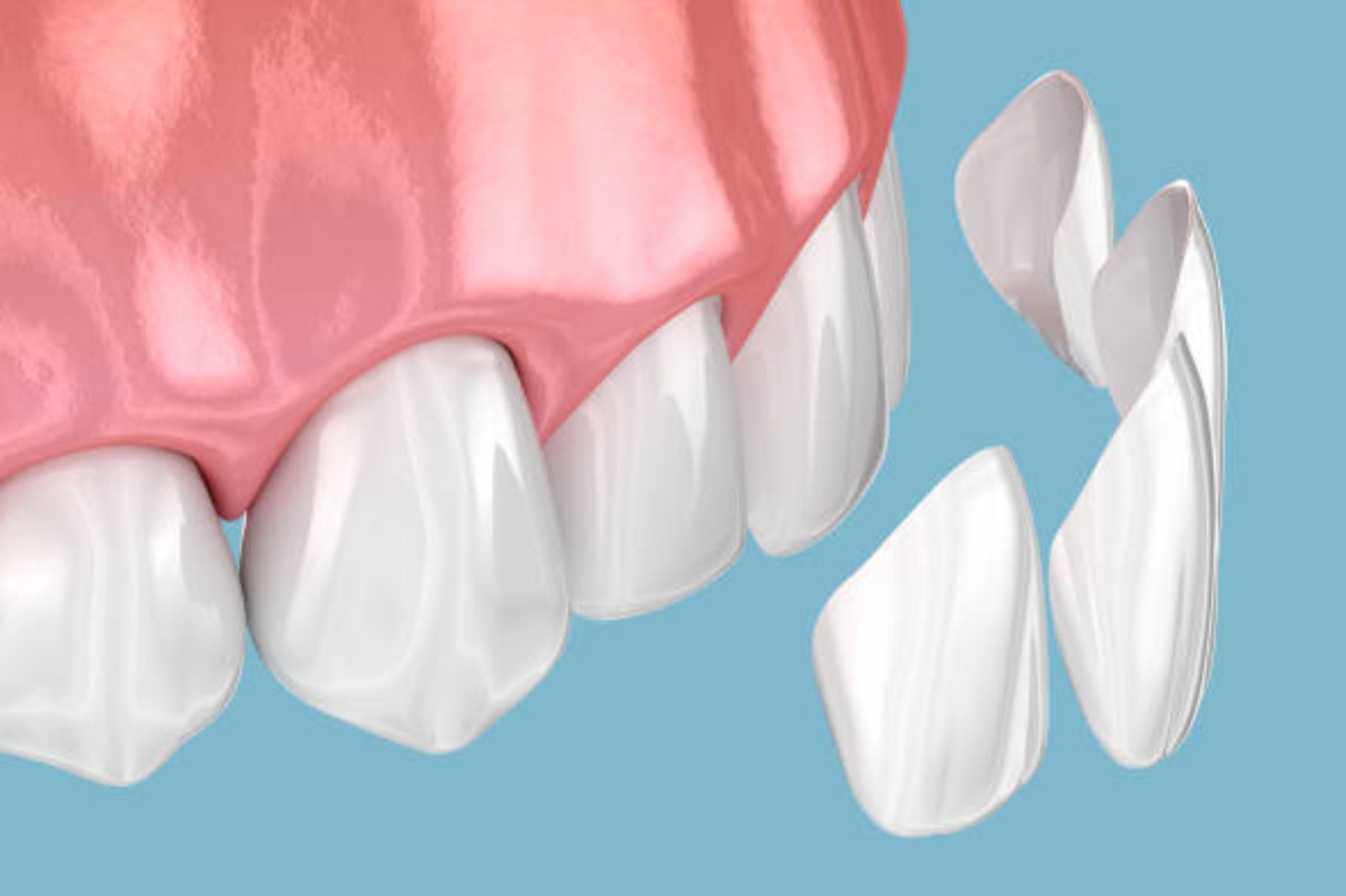 Dentist applying cosmetic bonding resin on a tooth