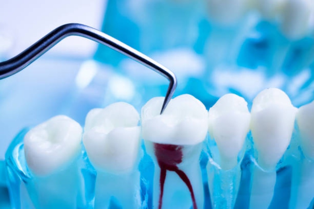 Everything You Need to Know About Root Canal Treatment