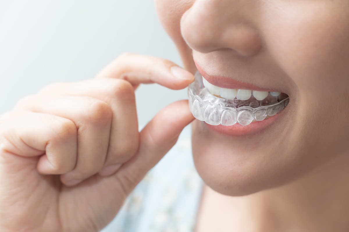 what to know before getting invisalign