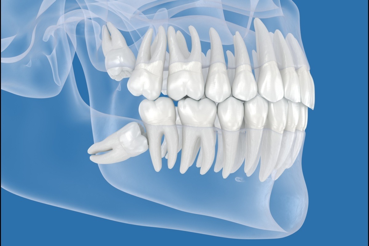 wisdom tooth pain and swelling