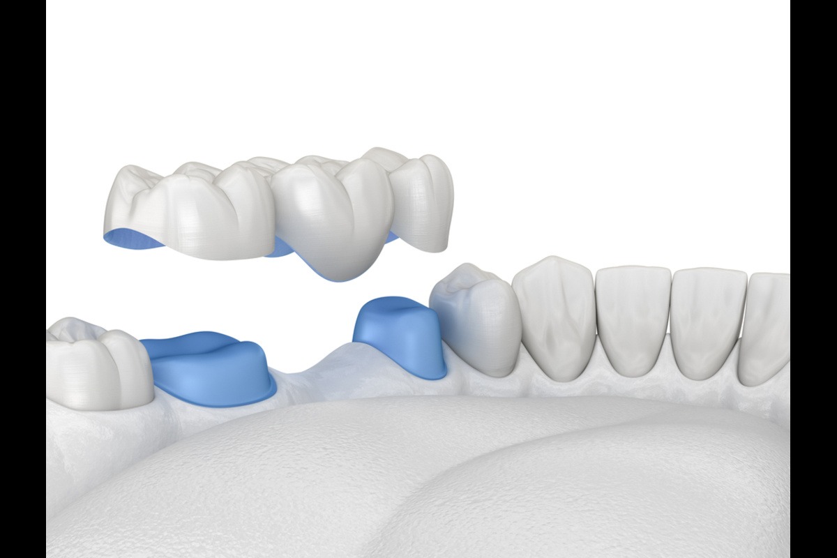front teeth spacing correction