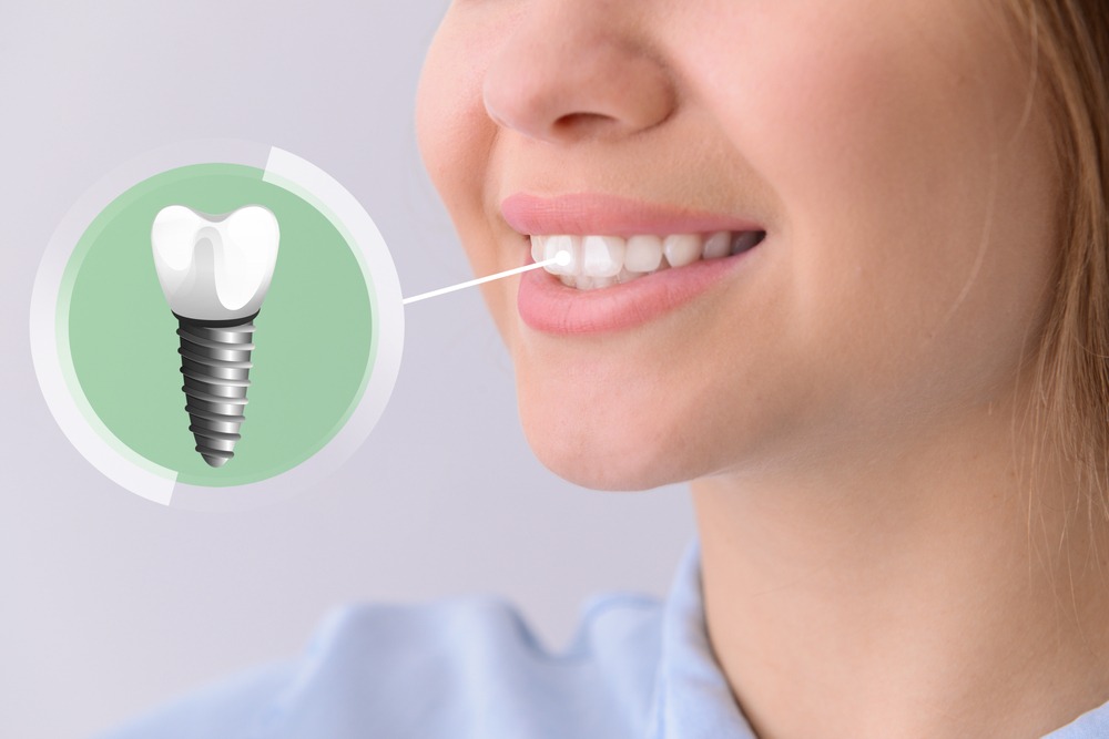 Young,Woman,With,Implanted,Teeth,On,Light,Background,,Closeup