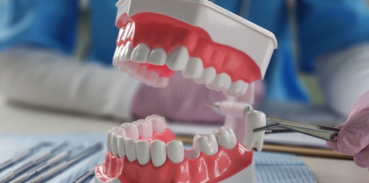 wisdom tooth removal